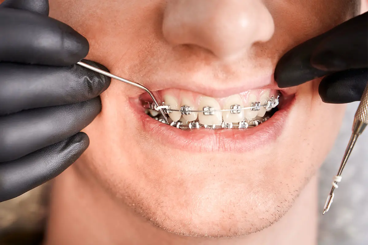 All on 6 İmplant Fiyatları