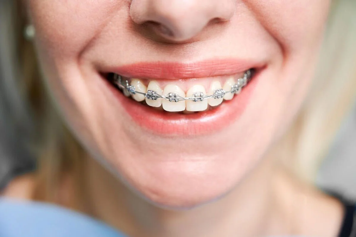 Ortodonti Diş Tedavisi Nedir