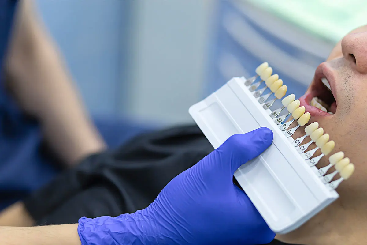 Laminate Veneer Fiyatları