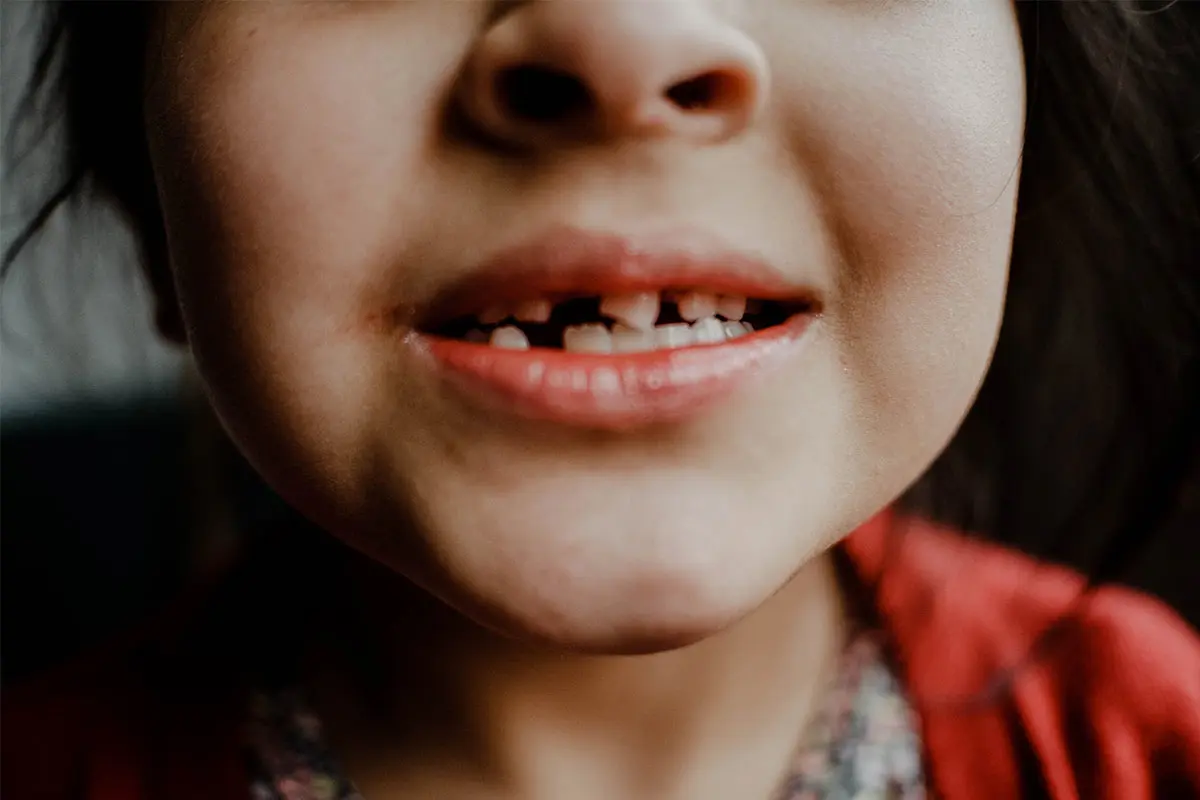 Çocuklarda Diş Eksikliği