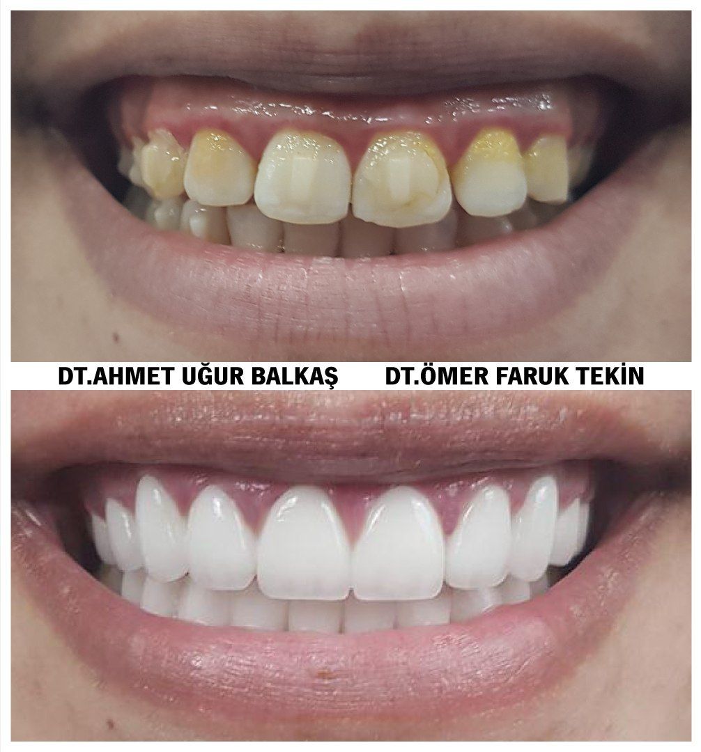 Mef Dental Grup المرضى من خارج القطر(الدوليين)