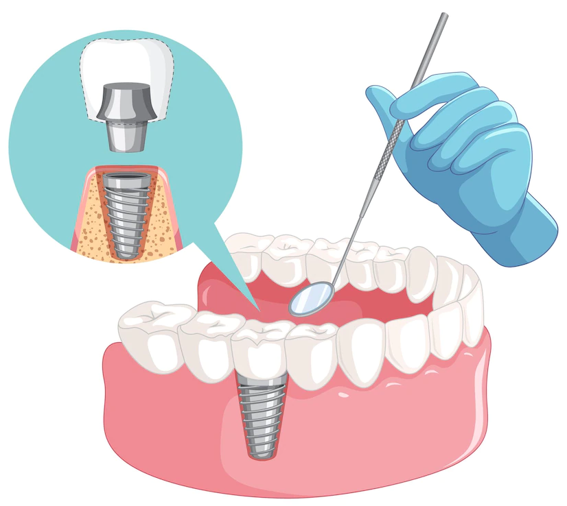Ağız Diş ve Çene Cerrahisi (Çekimler , İmplant Uygulamarı)